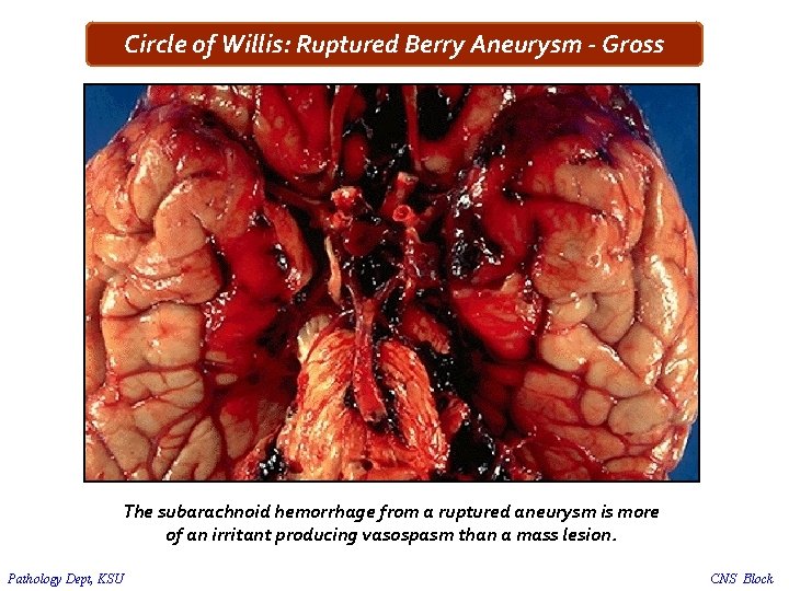 Circle of Willis: Ruptured Berry Aneurysm - Gross The subarachnoid hemorrhage from a ruptured