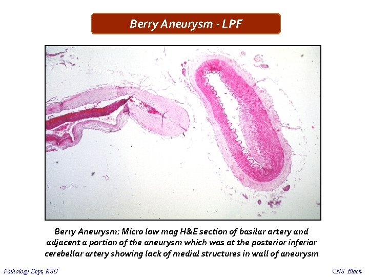 Berry Aneurysm - LPF Berry Aneurysm: Micro low mag H&E section of basilar artery