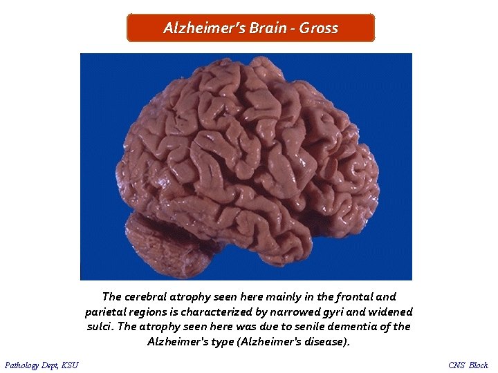 Alzheimer’s Brain - Gross The cerebral atrophy seen here mainly in the frontal and