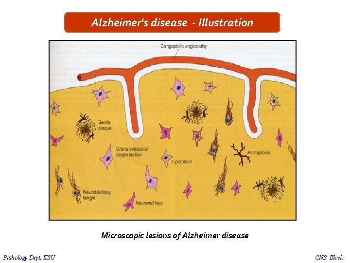 Alzheimer's disease - Illustration Microscopic lesions of Alzheimer disease Pathology Dept, KSU CNS Block