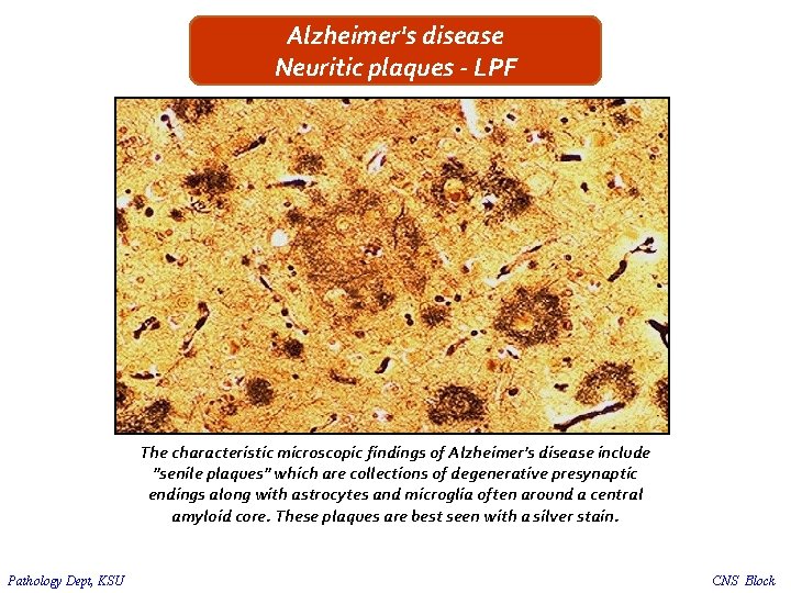 Alzheimer's disease Neuritic plaques - LPF The characteristic microscopic findings of Alzheimer's disease include