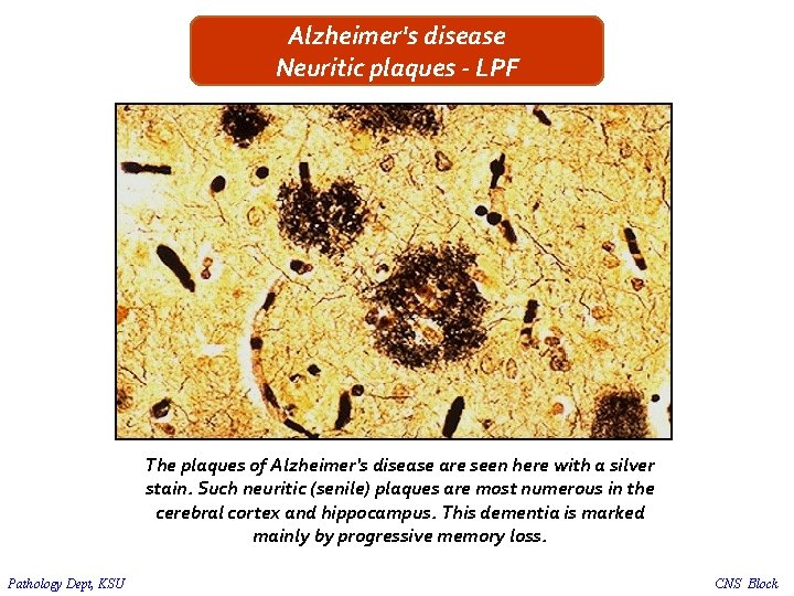 Alzheimer's disease Neuritic plaques - LPF The plaques of Alzheimer's disease are seen here