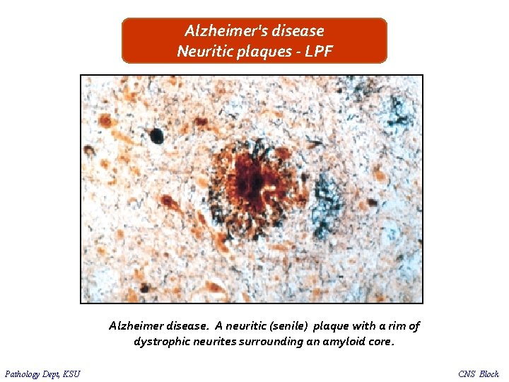 Alzheimer's disease Neuritic plaques - LPF Alzheimer disease. A neuritic (senile) plaque with a