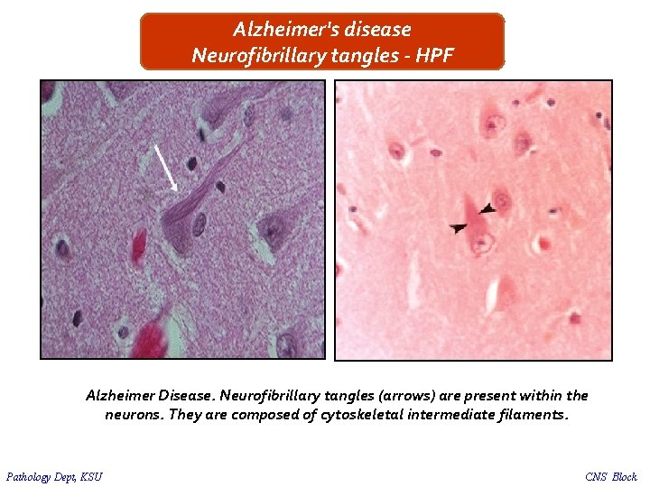 Alzheimer's disease Neurofibrillary tangles - HPF Alzheimer Disease. Neurofibrillary tangles (arrows) are present within