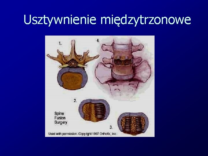 Usztywnienie międzytrzonowe 