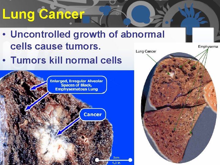 Lung Cancer • Uncontrolled growth of abnormal cells cause tumors. • Tumors kill normal Lung Cancer • Uncontrolled growth of abnormal cells cause tumors. • Tumors kill normal