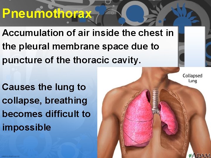 Pneumothorax Accumulation of air inside the chest in the pleural membrane space due to Pneumothorax Accumulation of air inside the chest in the pleural membrane space due to