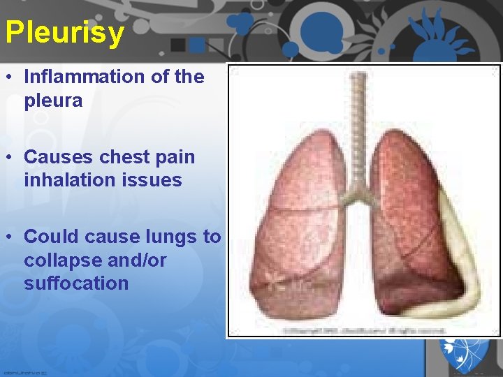 Pleurisy • Inflammation of the pleura • Causes chest pain inhalation issues • Could Pleurisy • Inflammation of the pleura • Causes chest pain inhalation issues • Could
