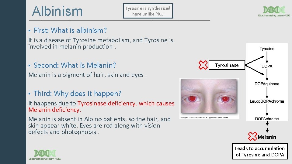 Albinism Tyrosine is synthesized here unlike PKU • First: What is albinism? It is