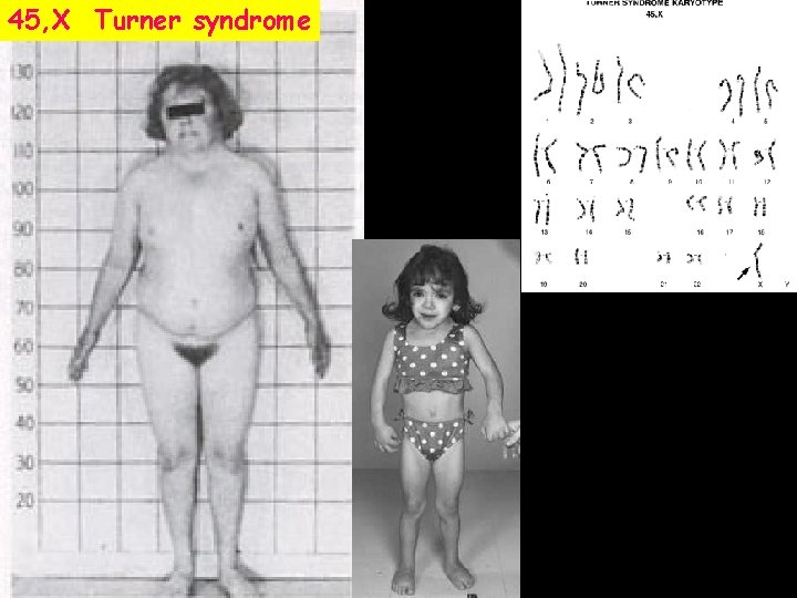 45, X Turner syndrome 