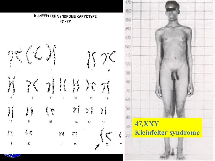 47, XXY Kleinfelter syndrome 