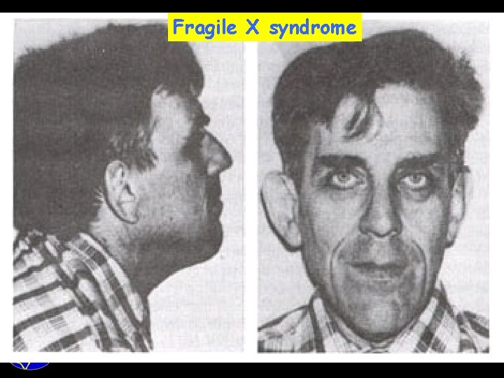 Fragile X syndrome 