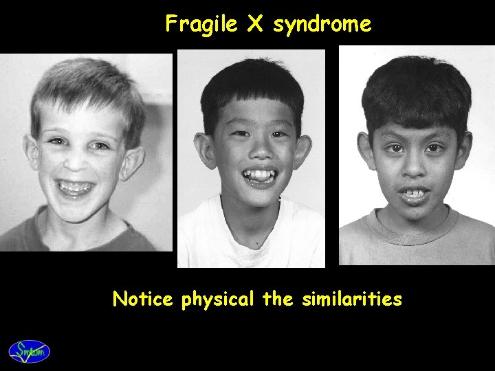 Fragile X syndrome Notice physical the similarities 