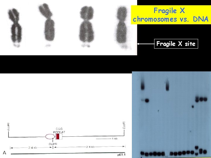 Fragile X chromosomes vs. DNA Fragile X site 