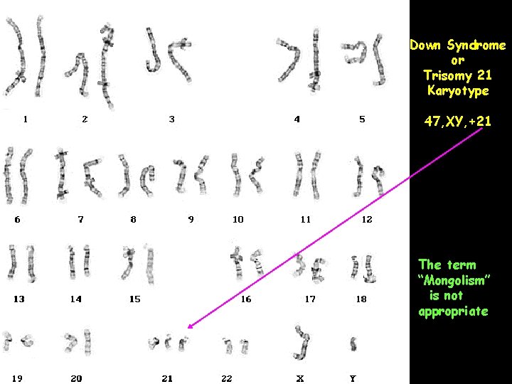 Down Syndrome or Trisomy 21 Karyotype 47, XY, +21 The term “Mongolism” is not