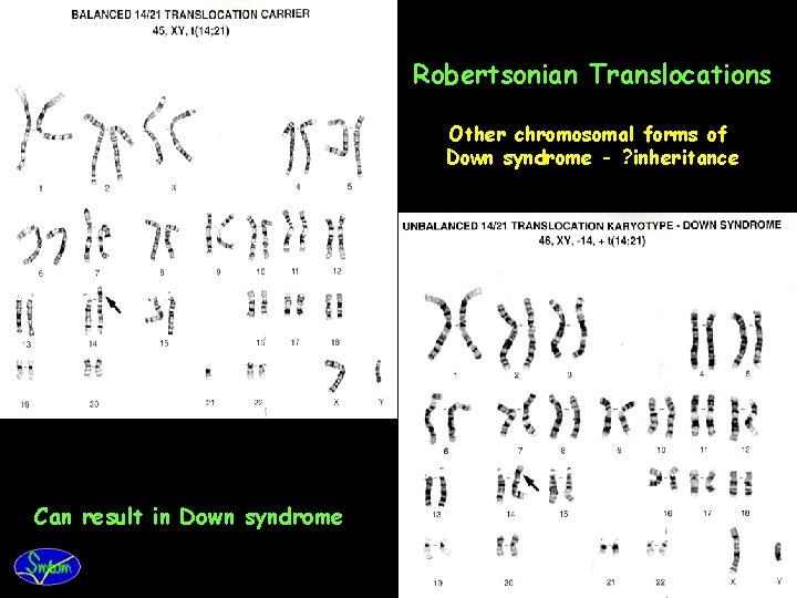 Robertsonian Translocations Other chromosomal forms of Down syndrome - ? inheritance Can result in