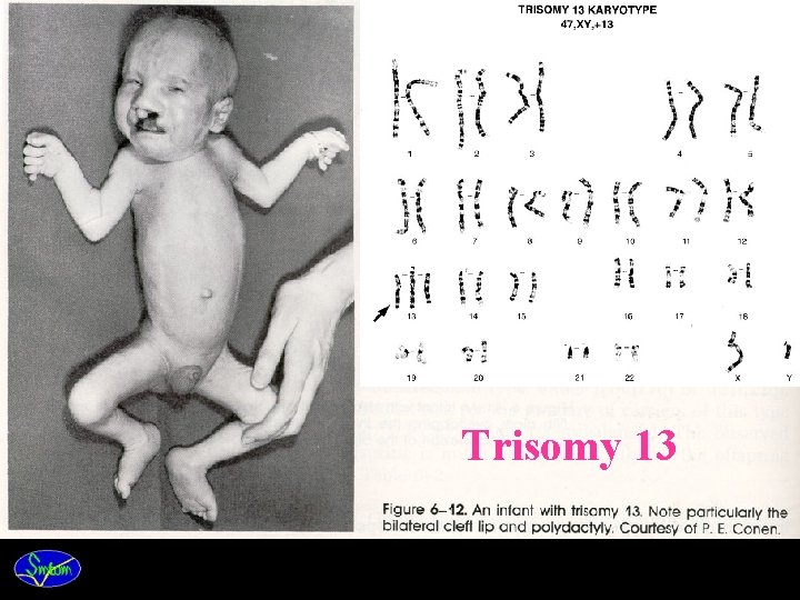 Trisomy 13 