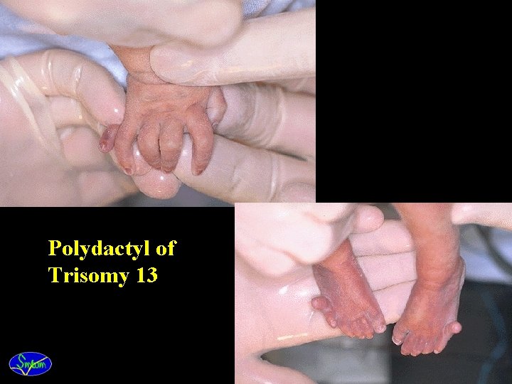 Polydactyl of Trisomy 13 