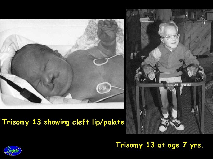 Trisomy 13 showing cleft lip/palate Trisomy 13 at age 7 yrs. 