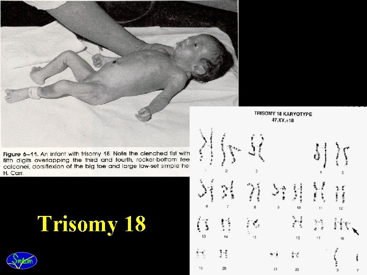 Trisomy 18 