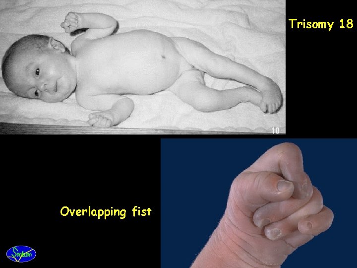 Trisomy 18 Overlapping fist 