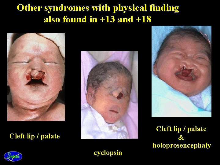 Other syndromes with physical finding also found in +13 and +18 Cleft lip /