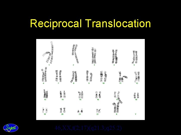 Reciprocal Translocation 46, XX, t(2; 17)(q 21. 3; q 25. 2) 