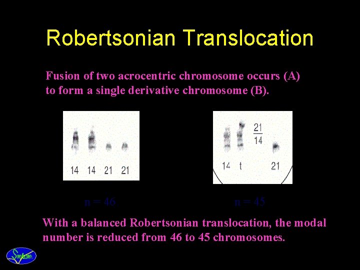 Robertsonian Translocation Fusion of two acrocentric chromosome occurs (A) to form a single derivative