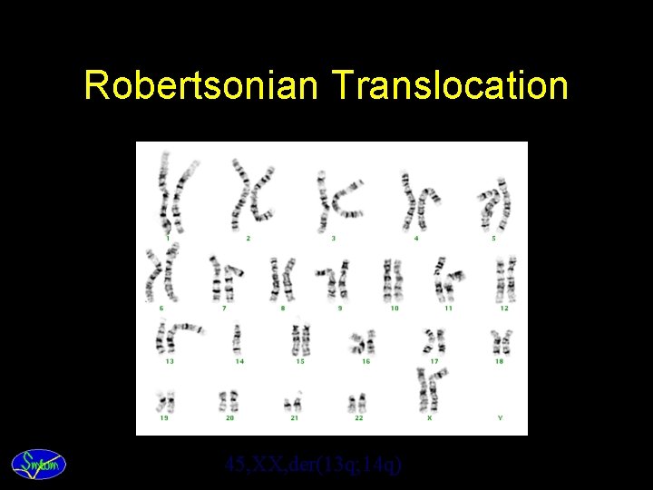 Robertsonian Translocation 45, XX, der(13 q; 14 q) 