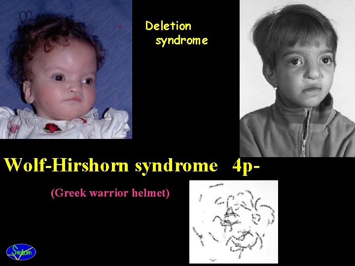 Deletion syndrome Wolf-Hirshorn syndrome 4 p(Greek warrior helmet) 