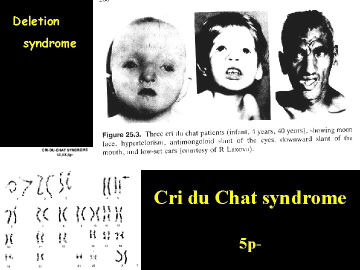 Deletion syndrome Cri du Chat syndrome 5 p- 