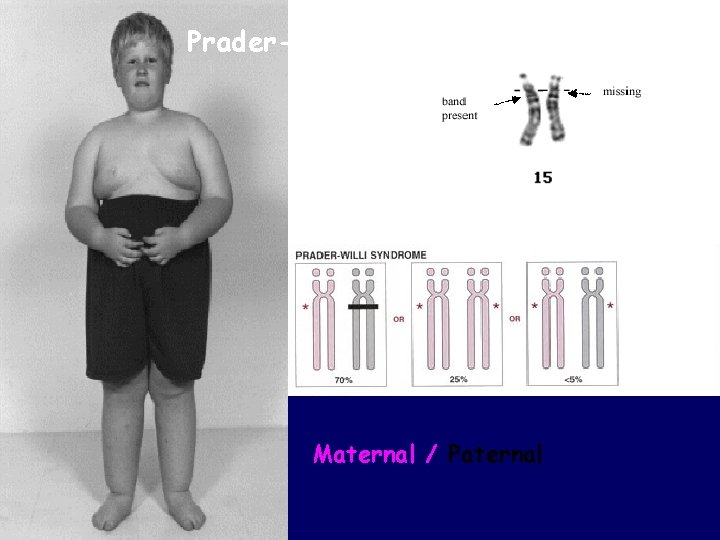 Prader-Willi syndrome Maternal / Paternal 