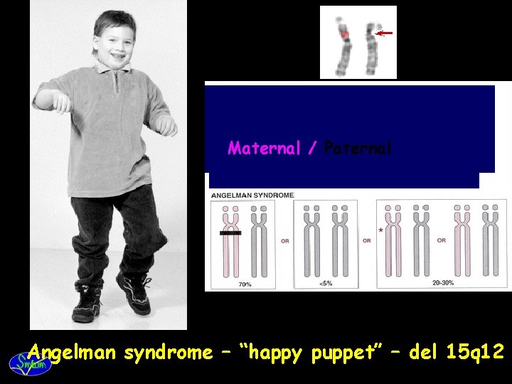 Maternal / Paternal Angelman syndrome – “happy puppet” – del 15 q 12 