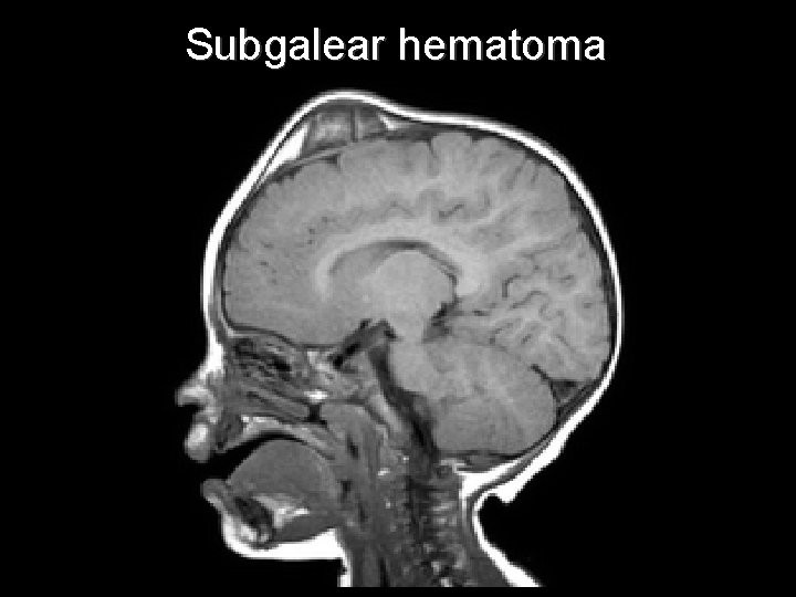 Subgalear hematoma 