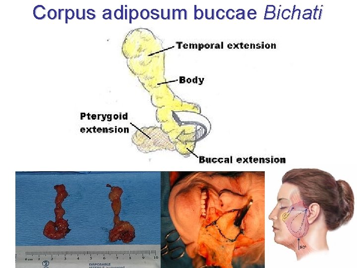 Corpus adiposum buccae Bichati 