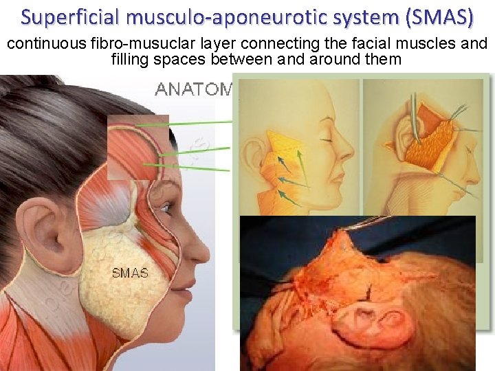 Superficial musculo-aponeurotic system (SMAS) continuous fibro-musuclar layer connecting the facial muscles and filling spaces