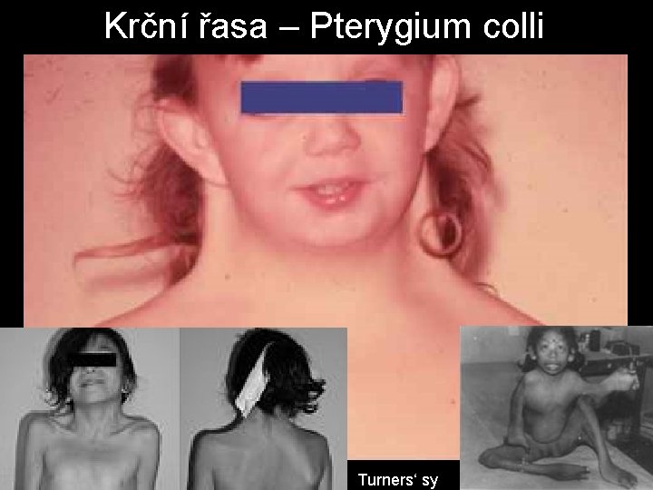 Krční řasa – Pterygium colli Turners‘ sy 