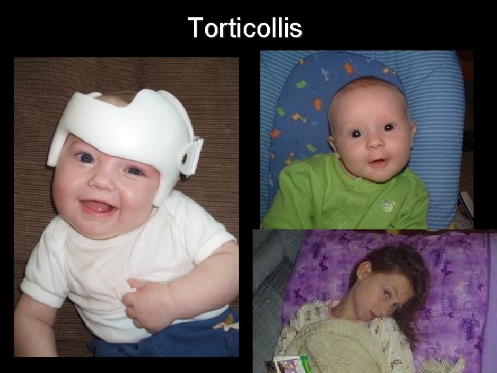 Torticollis 