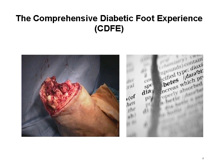 The Comprehensive Diabetic Foot Experience (CDFE) 6 