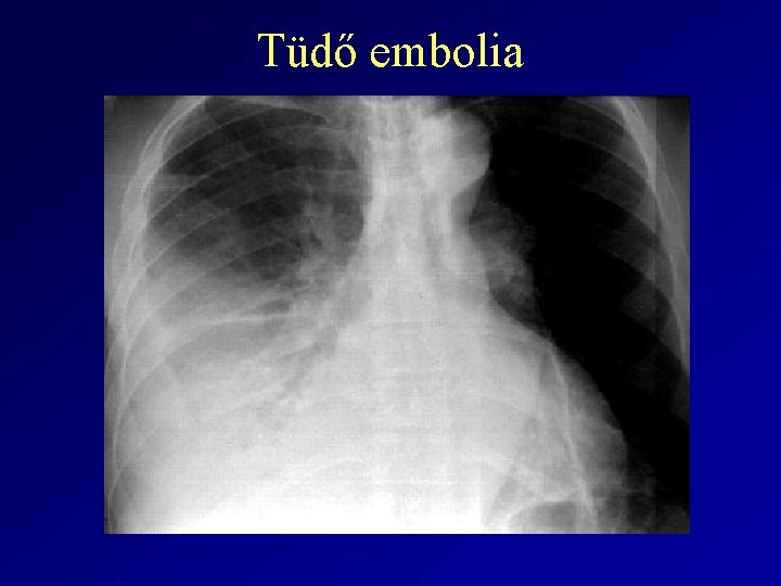 Tüdő embolia 