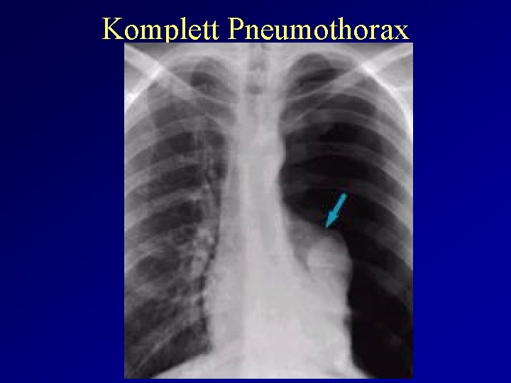 Komplett Pneumothorax 