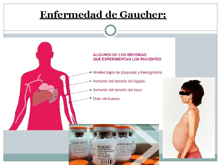 Enfermedad de Gaucher: 