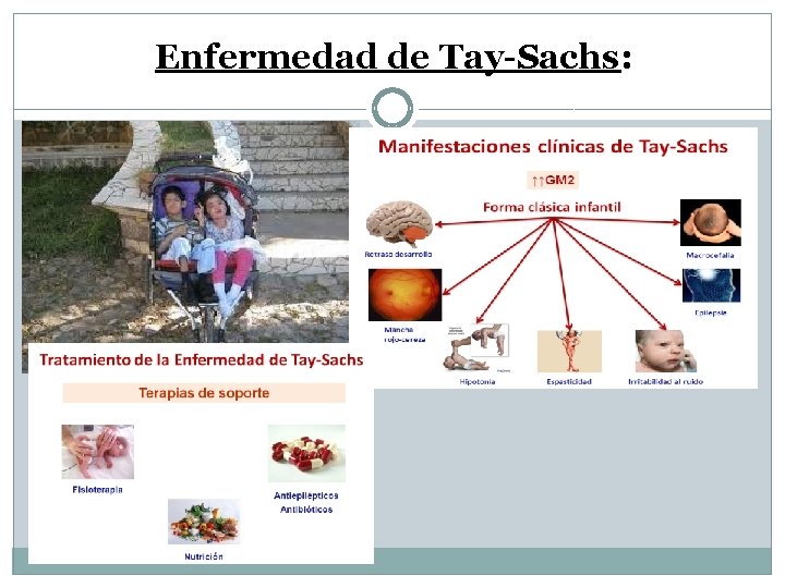 Enfermedad de Tay-Sachs: 