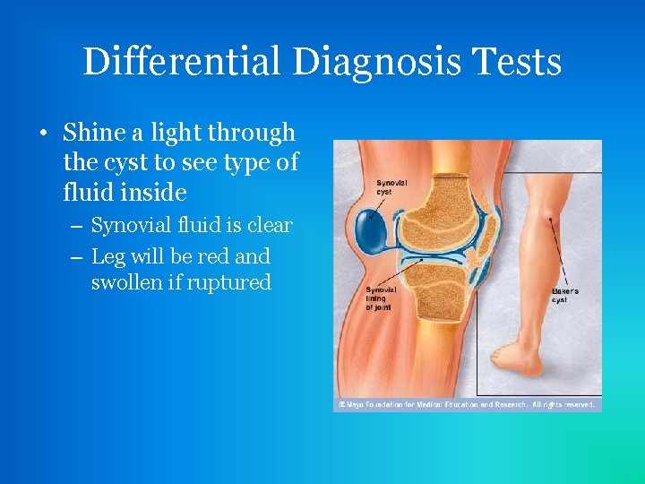 Differential Diagnosis Tests • Shine a light through the cyst to see type of
