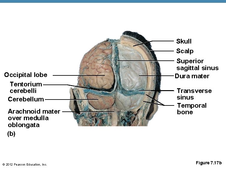 Skull Scalp Occipital lobe Tentorium cerebelli Cerebellum Arachnoid mater over medulla oblongata (b) ©