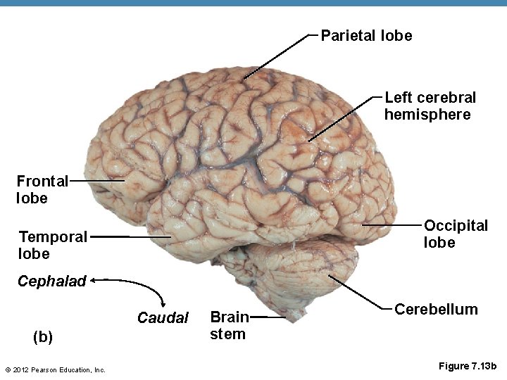 Parietal lobe Left cerebral hemisphere Frontal lobe Occipital lobe Temporal lobe Cephalad Caudal (b)