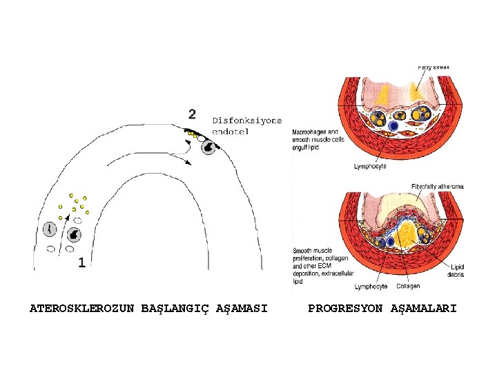 ATEROSKLEROZUN BAŞLANGIÇ AŞAMASI PROGRESYON AŞAMALARI 