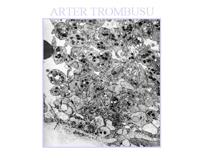 ARTER TROMBUSU 