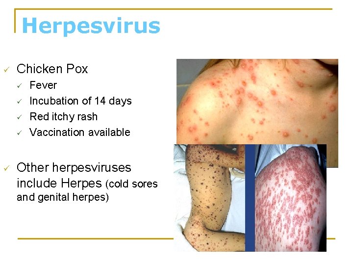 Herpesvirus ü Chicken Pox ü ü ü Fever Incubation of 14 days Red itchy