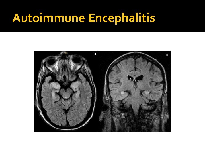 Autoimmune Encephalitis 